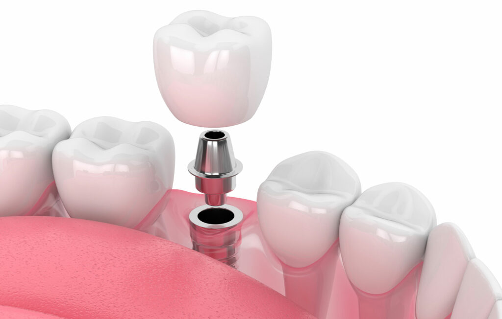 implant restoration