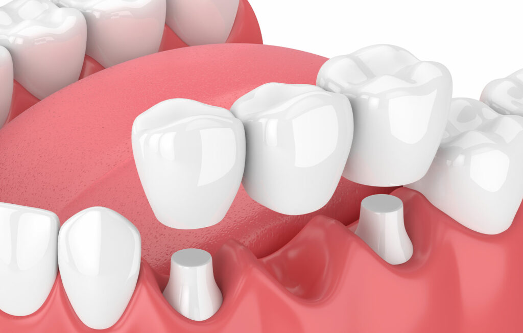 dental bridges