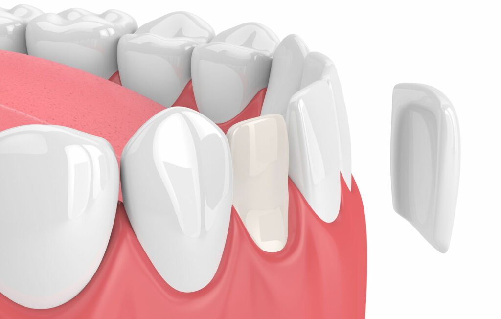 porcelain restorations