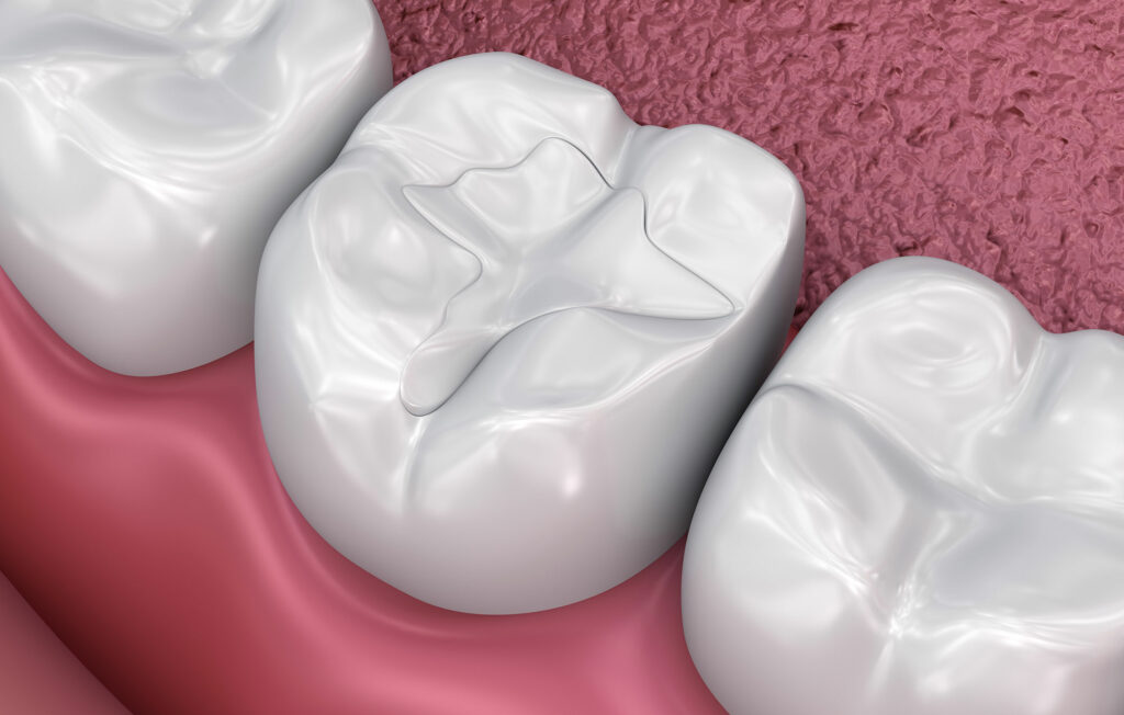 Do You Need A Dental Filling?, Cavity Fillings